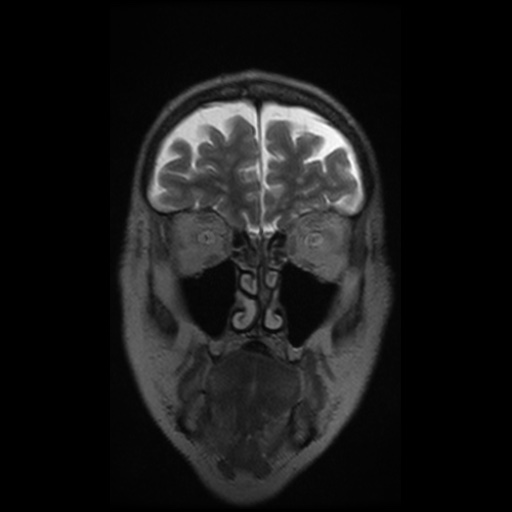 Balo concentric sclerosis (Radiopaedia 53875-59982 Coronal T2 36).jpg