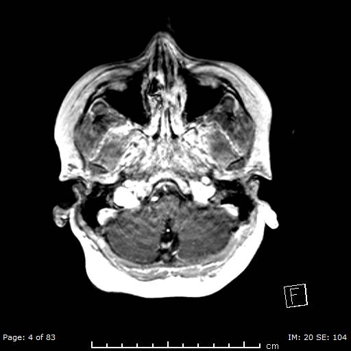 Balo concentric sclerosis (Radiopaedia 61637-69636 Axial T1 C+ 4).jpg