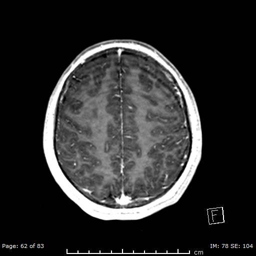 Balo concentric sclerosis (Radiopaedia 61637-69636 Axial T1 C+ 62).jpg