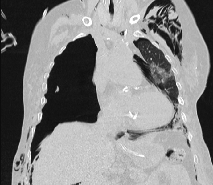 Barotrauma due to mechanical ventilation (Radiopaedia 28079-28336 Coronal lung window 44).jpg