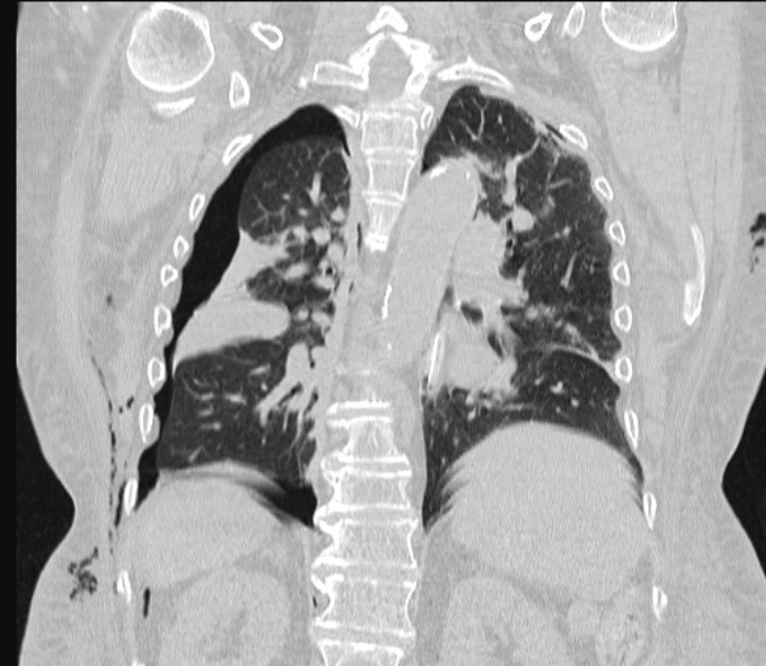 Barotrauma due to mechanical ventilation (Radiopaedia 28079-28336 Coronal lung window 64).jpg