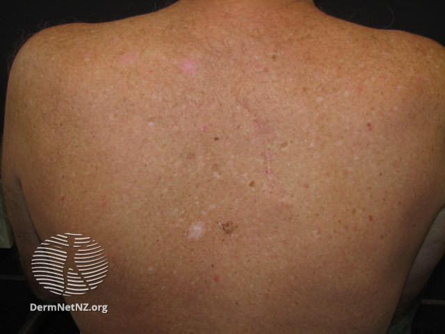 File:Basal cell carcinoma affecting the trunk (DermNet NZ lesions-bcc-trunk-0688).jpg