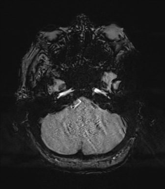 Basal ganglia metastasis (Radiopaedia 78928-91828 Axial SWI 15).png
