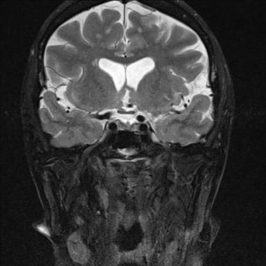 File:Base of skull chondrosarcoma (Radiopaedia 30410-31070 Coronal T2 fat sat 16).jpg