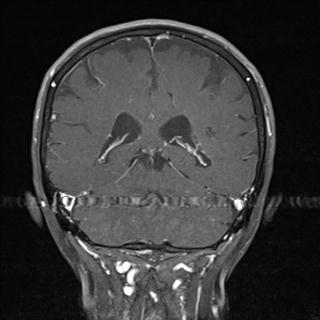 File:Base of skull chondrosarcoma (Radiopaedia 30410-31070 G 19).jpg