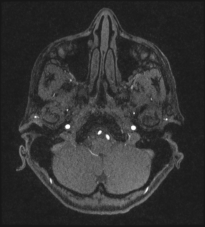 Basilar artery perforator aneurysm (Radiopaedia 82455-97733 Axial MRA 41).jpg