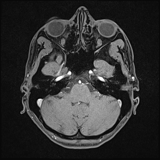 Basilar artery perforator aneurysm (Radiopaedia 82455-97733 Axial T1 fat sat 33).jpg