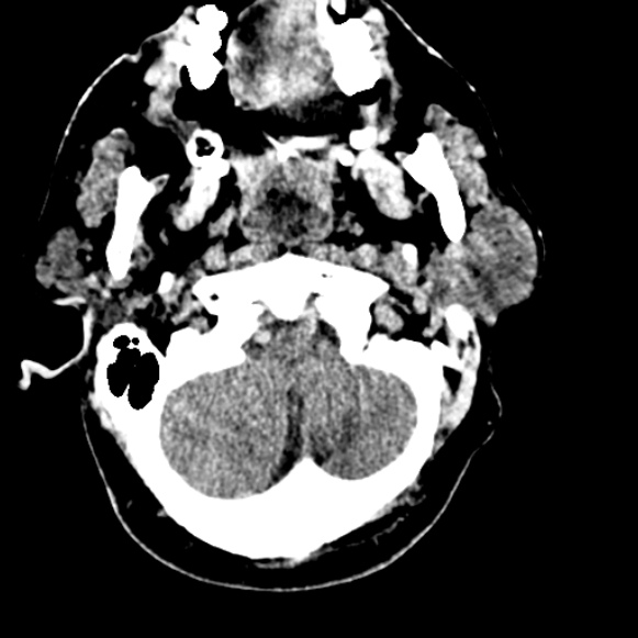File:Basilar artery thrombosis (Radiopaedia 53351-59333 Axial non-contrast 22).jpg