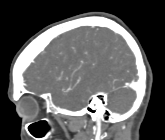 Basilar tip aneurysm with coiling (Radiopaedia 53912-60086 C 26).jpg