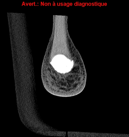 File:Baxter neuropathy (Radiopaedia 25988-26125 Coronal non-contrast 56).jpg