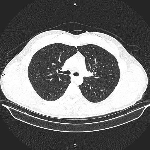 Beam hardening and ring artifacts (Radiopaedia 85323-100915 Axial lung window 31).jpg