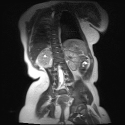 File:Beckwith-Wiedeman syndrome with bilateral Wilms tumors (Radiopaedia 60850-69233 B 7).jpg