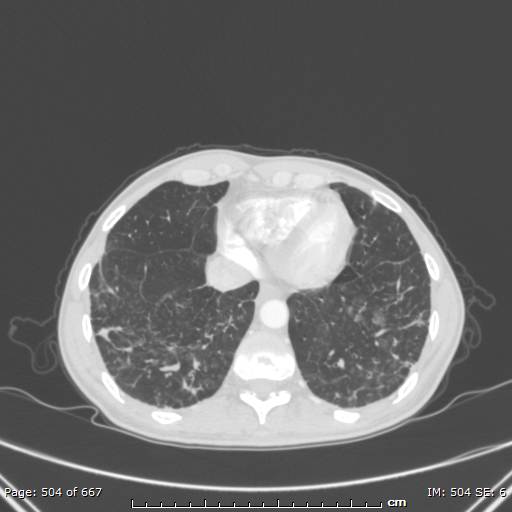 File:Behçet disease (Radiopaedia 44247-47889 Axial lung window 69).jpg