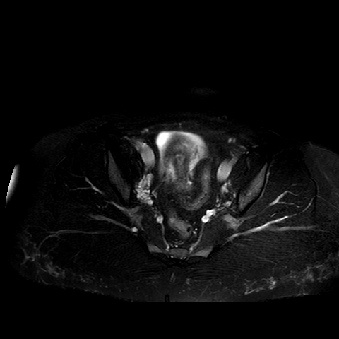 File:Benign seromucinous cystadenoma of the ovary (Radiopaedia 71065-81300 T2 SPAIR 9).jpg