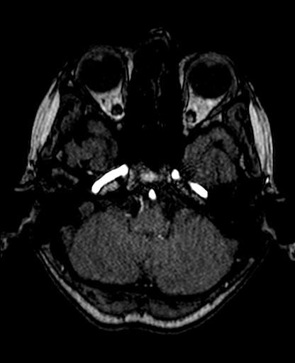 File:Berry aneurysm of the terminal internal carotid artery (Radiopaedia 88286-104918 Axial TOF 67).jpg