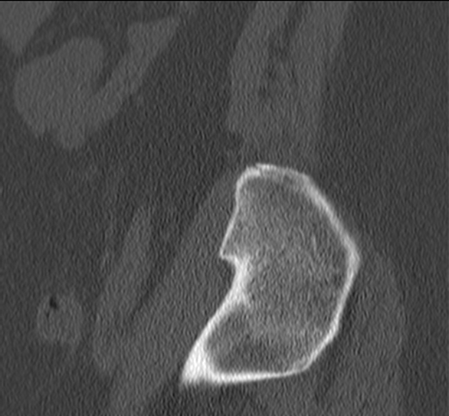Bertolotti syndrome (Radiopaedia 24864-25128 Sagittal bone window 56).jpg