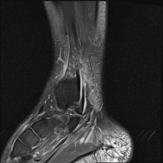 File:Bilateral Achilles tendon complete tear (Radiopaedia 81344-95051 Sagittal T2 fat sat 17).jpg