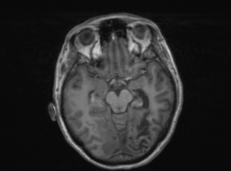 Bilateral PCA territory infarction - different ages (Radiopaedia 46200-51784 Axial T1 265).jpg