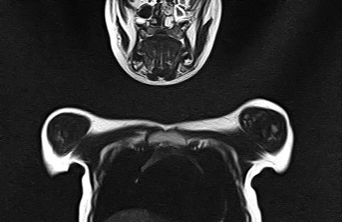 File:Bilateral Sprengel deformity with Klippel-Feil syndrome (Radiopaedia 66395-75650 Coronal T2 3).jpg