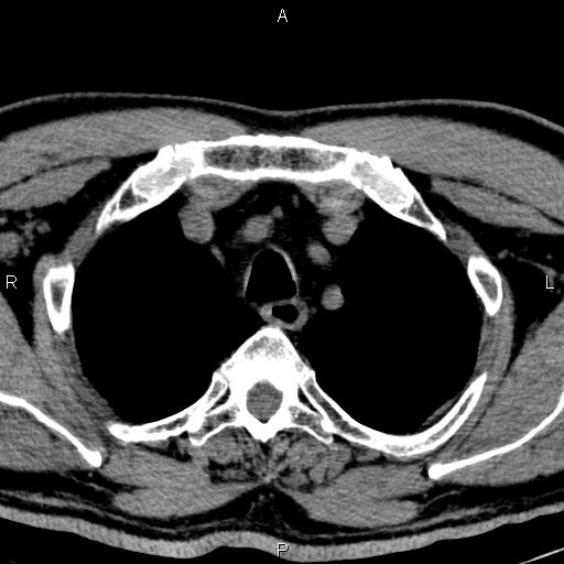 Bilateral Warthin tumors (Radiopaedia 84034-99263 Axial non-contrast 68).jpg