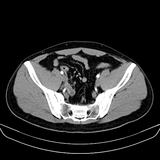 Bilateral accessory renal arteries with mild pelvi-ureteric junction (PUJ) obstruction (Radiopaedia 66357-75596 A 56).jpg