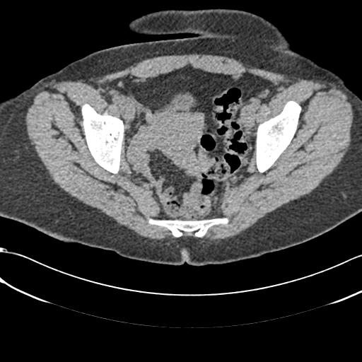 Bilateral acetabular protrusion with pincer type femoro-acetabular impingement (Radiopaedia 30134-30733 AXIAL SOFT THIN 13).jpg