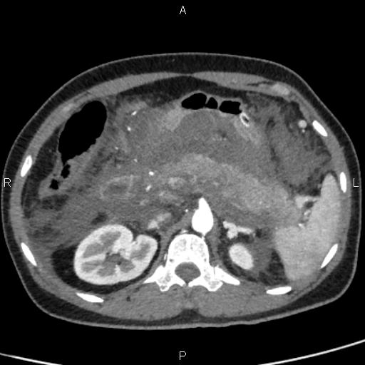 Bilateral adrenal gland hyperenhancement in pancreatitis (Radiopaedia 86642-102753 B 45).jpg