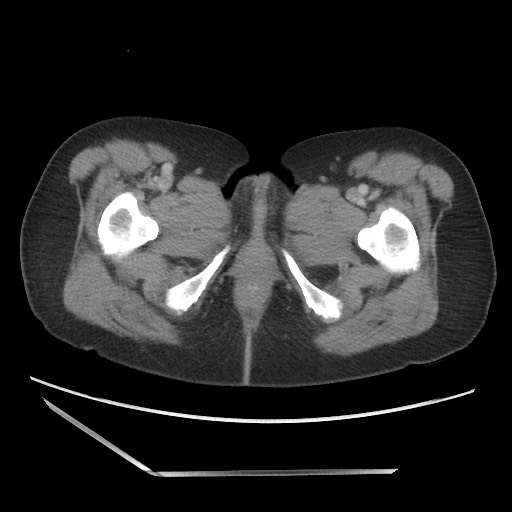 File:Bilateral adrenal granulocytic sarcomas (chloromas) (Radiopaedia 78375-91007 A 130).jpg