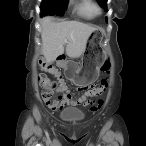 Bilateral adrenal granulocytic sarcomas (chloromas) (Radiopaedia 78375-91007 B 27).jpg