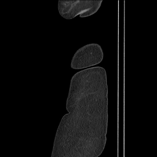File:Bilateral adrenal granulocytic sarcomas (chloromas) (Radiopaedia 78375-91007 C 13).jpg