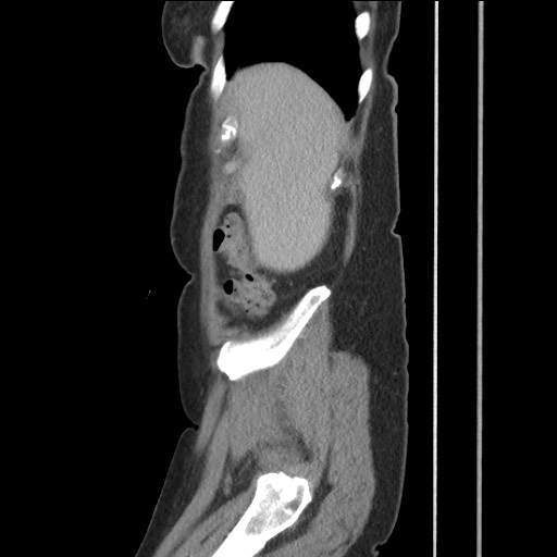 File:Bilateral adrenal granulocytic sarcomas (chloromas) (Radiopaedia 78375-91007 C 30).jpg
