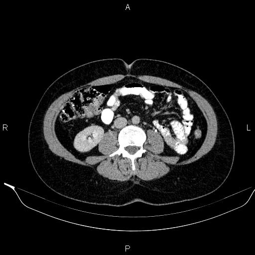 Bilateral adrenal myelolipoma (Radiopaedia 63058-71535 Axial C+ delayed 78).jpg