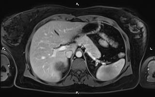Bilateral adrenal myelolipoma (Radiopaedia 63058-71537 G 29).jpg