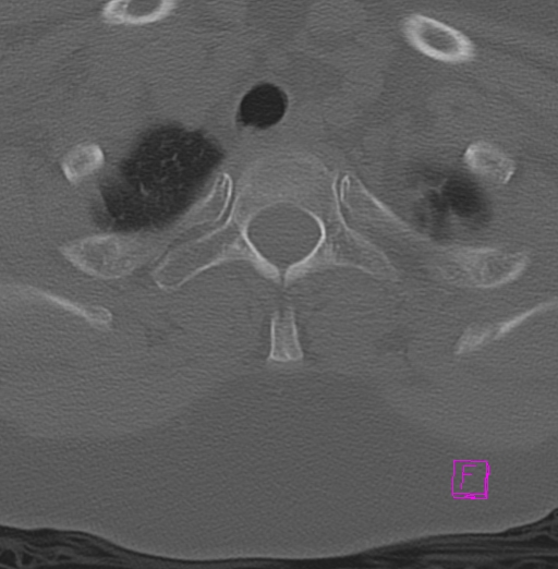 File:Bilateral atlanto-occipital assimilation (Radiopaedia 28350-28603 Axial bone window 45).jpg