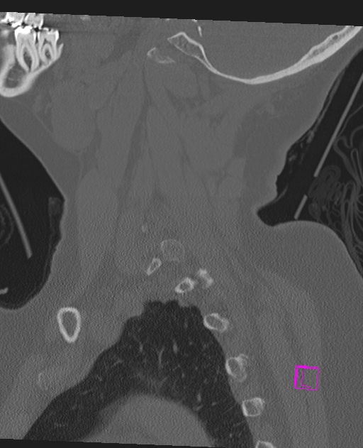Bilateral atlanto-occipital assimilation (Radiopaedia 28350-28603 Sagittal bone window 19).jpg