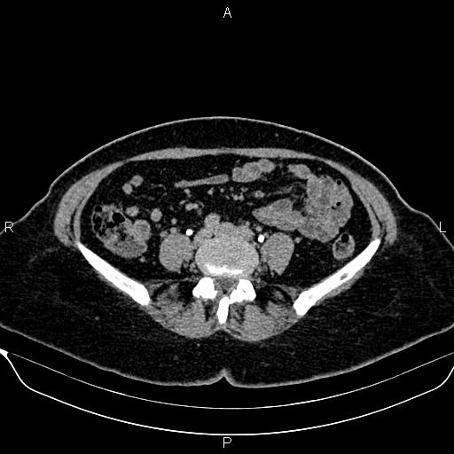 Bilateral benign adrenal adenomas (Radiopaedia 86912-103124 Axial C+ delayed 104).jpg