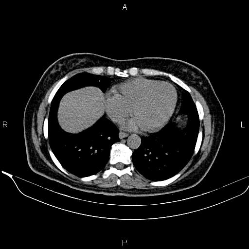Bilateral benign adrenal adenomas (Radiopaedia 86912-103124 Axial non-contrast 11).jpg