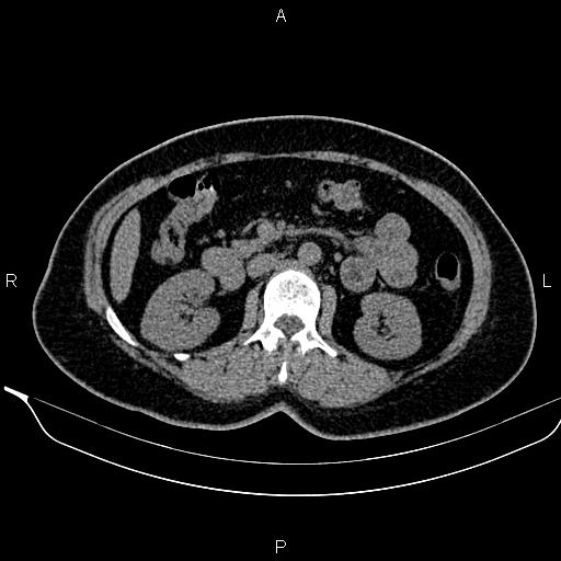 Bilateral benign adrenal adenomas (Radiopaedia 86912-103124 Axial non-contrast 52).jpg