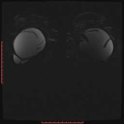 File:Bilateral breast implant rupture (Radiopaedia 24761-25027 PASTA Si IR 15).jpg