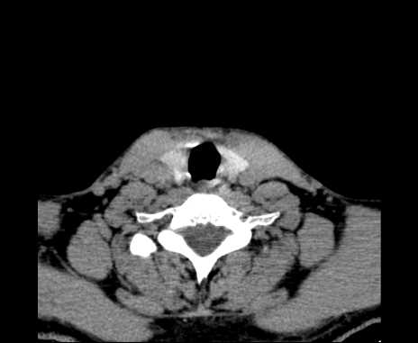 Bilateral carotid body tumors (Radiopaedia 61841-69870 Axial non-contrast 89).jpg