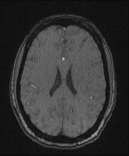 Bilateral carotid body tumors and right glomus jugulare tumor (Radiopaedia 20024-20060 Axial MRA 118).jpg