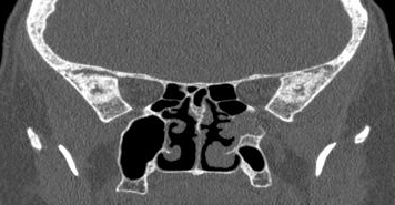 File:Bilateral ectopic infraorbital nerves (Radiopaedia 49006-54084 Coronal 12).png