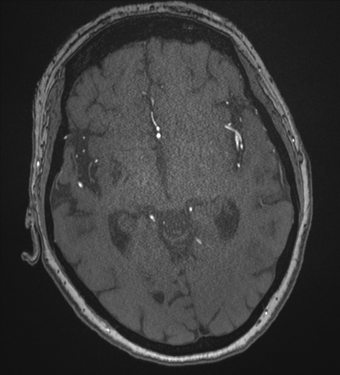 Bilateral fetal posterior communicating arteries (Radiopaedia 41286-44102 Axial MRA 100).png