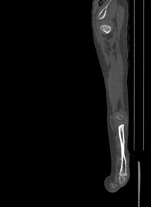 Bilateral fibular hemimelia type II (Radiopaedia 69581-79491 Sagittal bone window 28).jpg