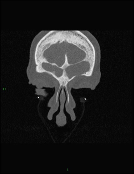 Bilateral frontal mucoceles (Radiopaedia 82352-96454 Coronal 56).jpg