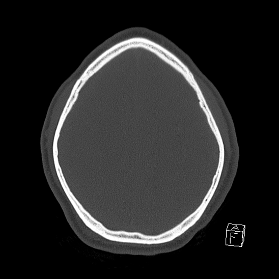 Bilateral occipital condyle fracture (type 2) (Radiopaedia 87675-104089 Axial bone window 103).jpg
