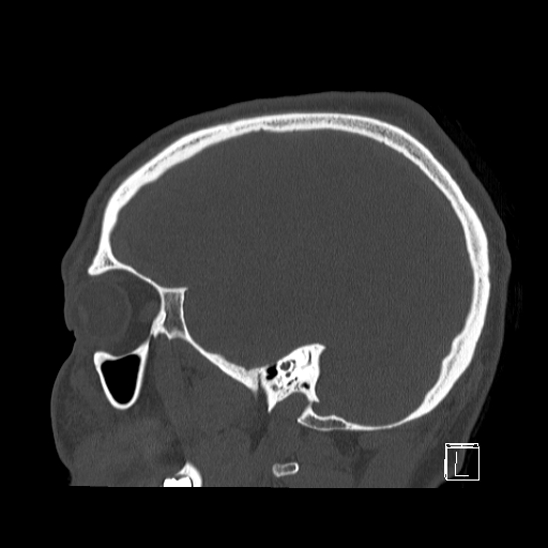 Bilateral occipital condyle fracture (type 2) (Radiopaedia 87675-104089 Sagittal bone window 88).jpg