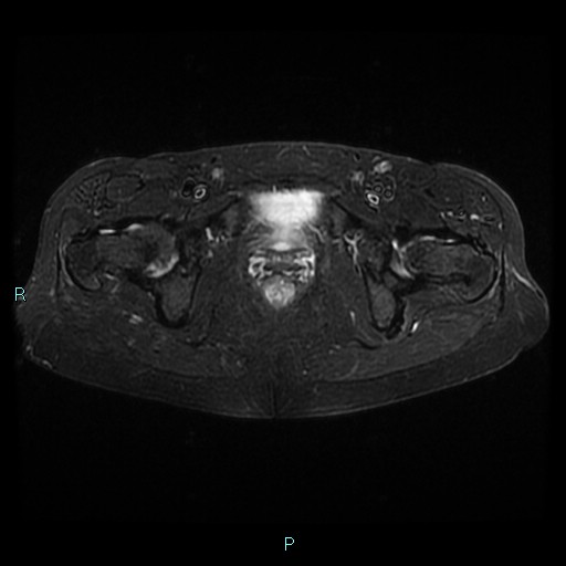 File:Bilateral ovarian fibroma (Radiopaedia 44568-48293 Axial STIR 24).jpg