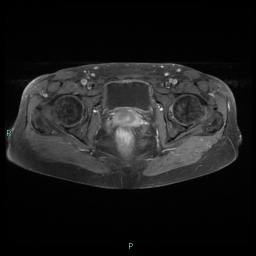File:Bilateral ovarian fibroma (Radiopaedia 44568-48293 Axial T1 C+ fat sat 22).jpg