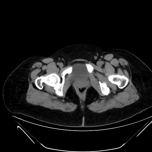 Bilateral ovarian mature cystic teratomas (Radiopaedia 79373-92457 Axial non-contrast 91).jpg